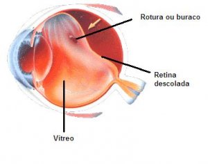 Deslocamento de retina